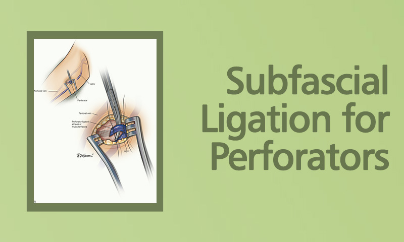 Subfascial Ligation For Perforators