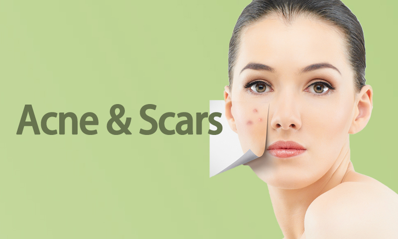 Acne & Scars Treatment in Surat, Gujarat (India)