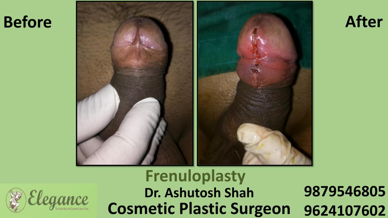 Frenuloplasty Surgery in Surat, Gujarat (India)