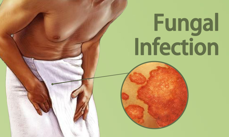Fungal Infection Treatment in Surat, Gujarat (India)