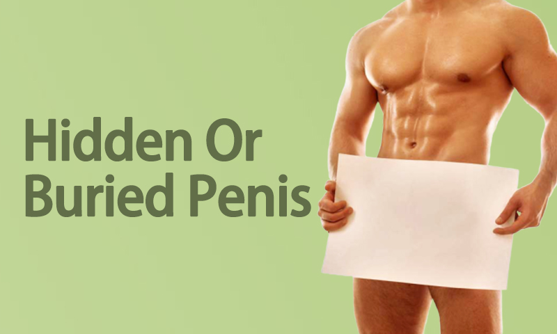 Hidden Or Buried Penis Surgery in Surat, Gujarat (India)