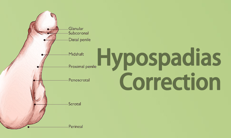 Hypospadias Correction Surgery in Surat (Gujarat) India