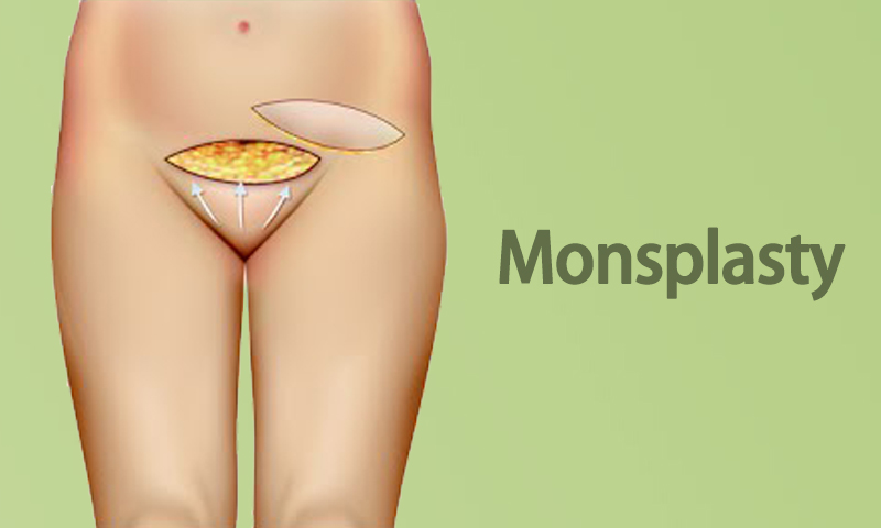 Monsplasty Surgery in Surat, Gujarat (India)