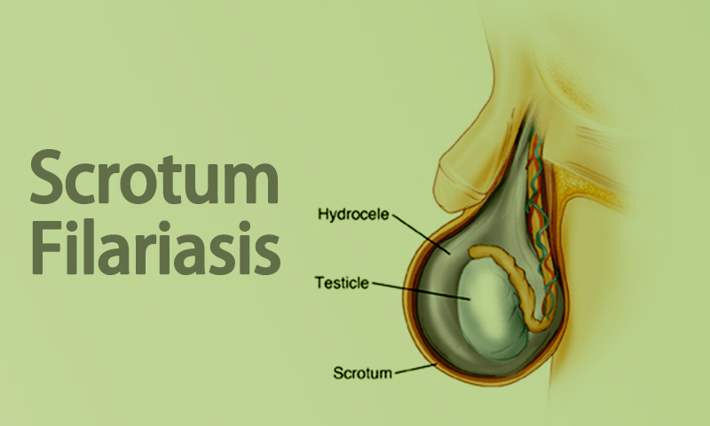 Scrotum Filariasis Treatment in Surat, Gujarat (India)