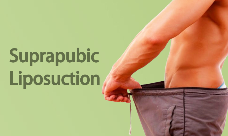 Suprapubic Liposuction Surgery in Surat, Gujarat (India)