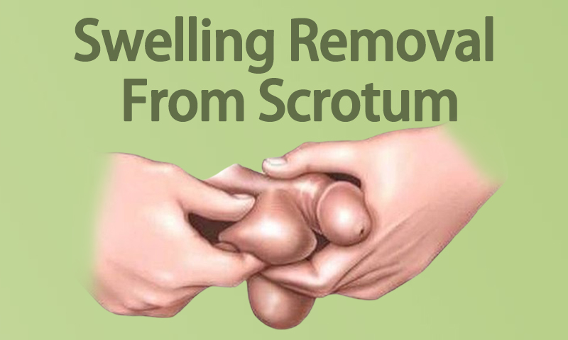 Scrotum Swelling Removal in Surat, Gujarat (India)