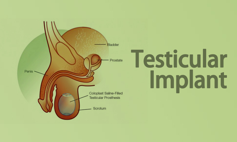 Testicular Implant Surgery in Surat, Gujarat (India)