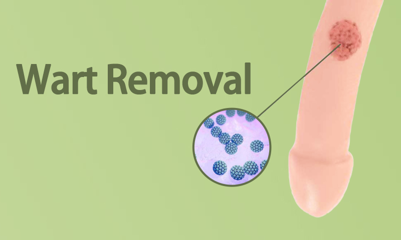 Wart Removal in Surat, Gujarat (India)