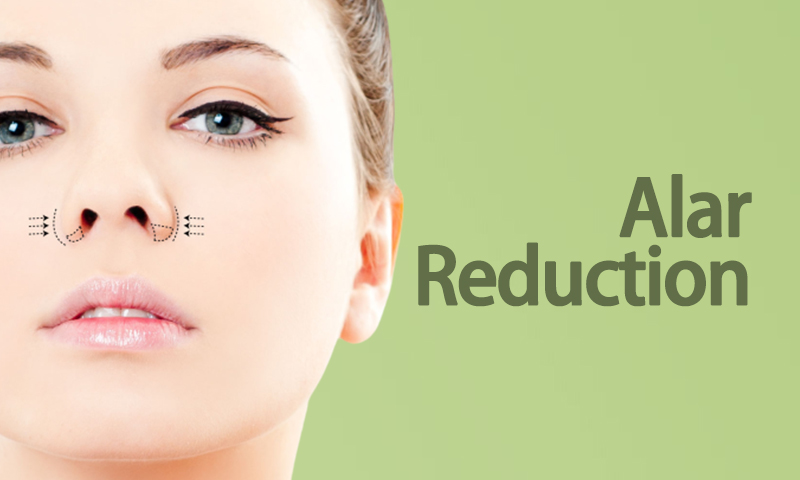 Alar Reduction