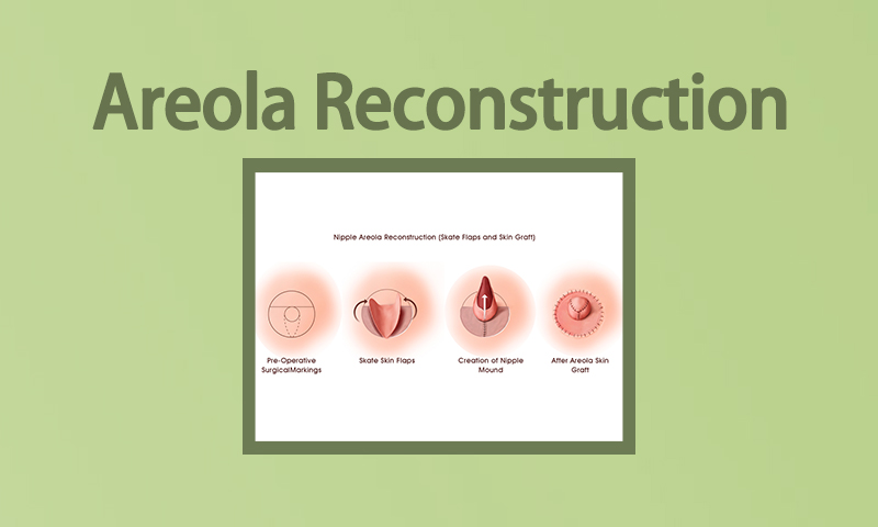 Areola Reconstruction Breast Surgery in Surat, Gujarat (India)