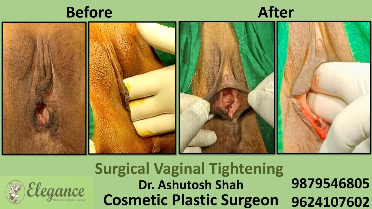 Surgical Vaginal Tightening (Vaginoplasty) in Surat, Gujarat (India)