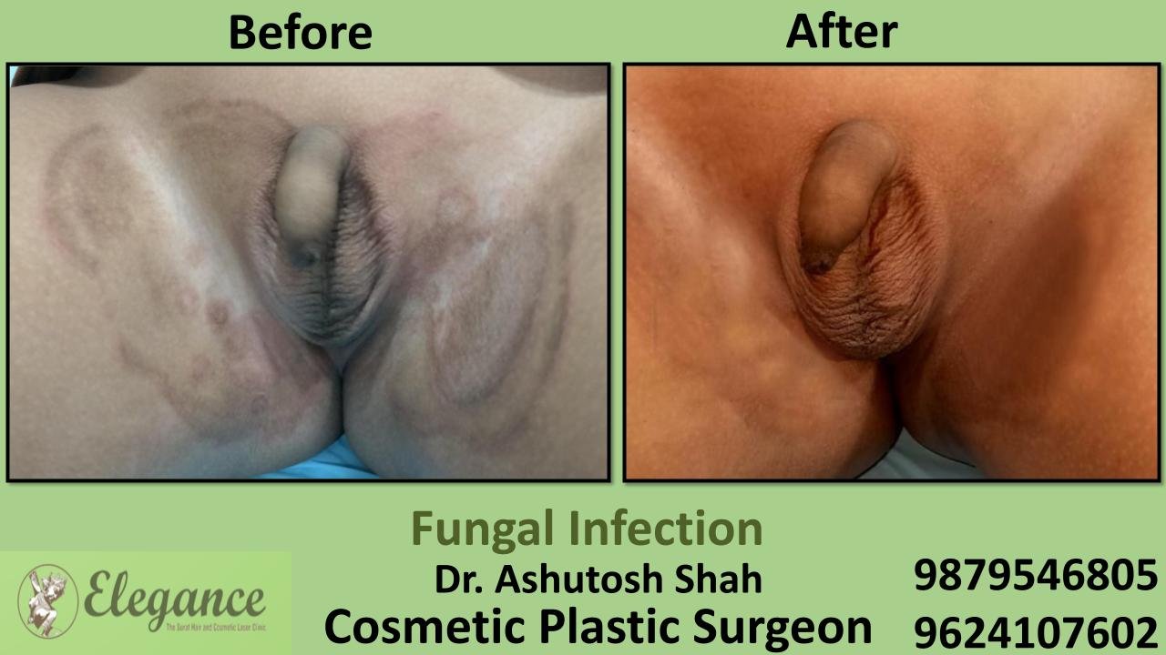 Fungal Infection Treatment in Surat, Gujarat (India)