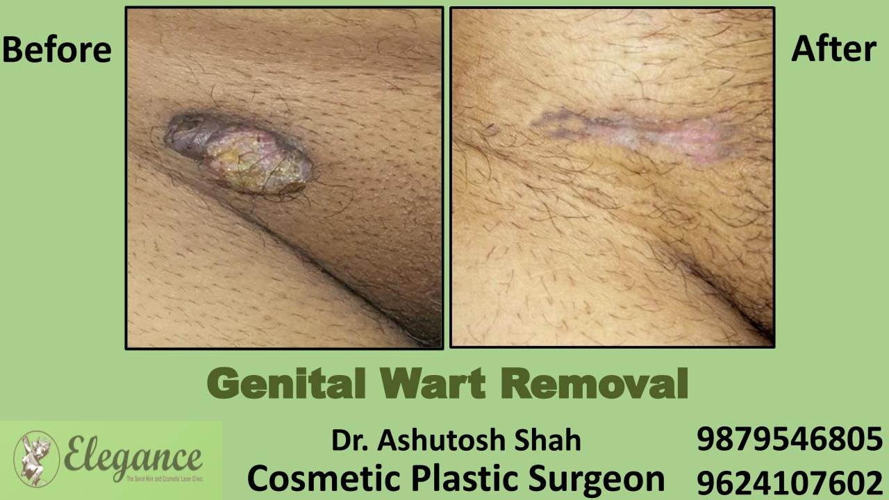 Wart Removal in Surat, Gujarat (India)