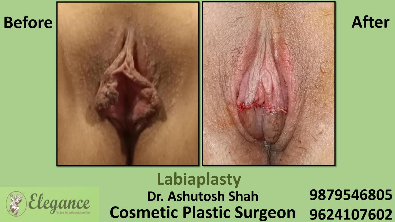 Labiaplasty Surgery in Surat, Gujarat (India)