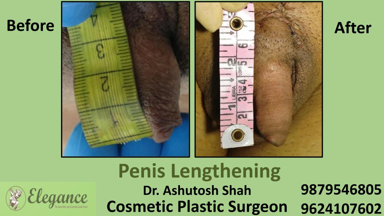 Penile Lengthening in Surat, Gujarat (India)