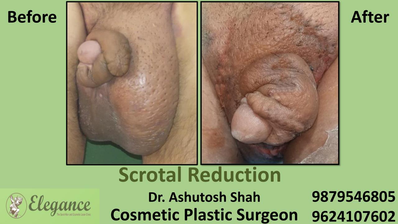Scrotal Reduction Treatment in Surat, Gujarat (India)