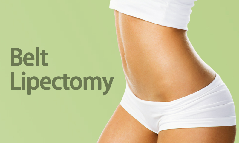 Belt Lipectomy