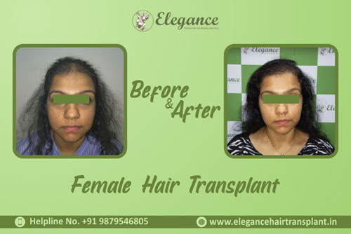 Before & After Results of Hair Transplant in Females