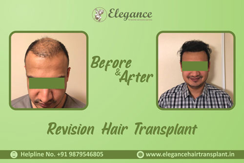 Before & After Results of Hair Transplant in Males