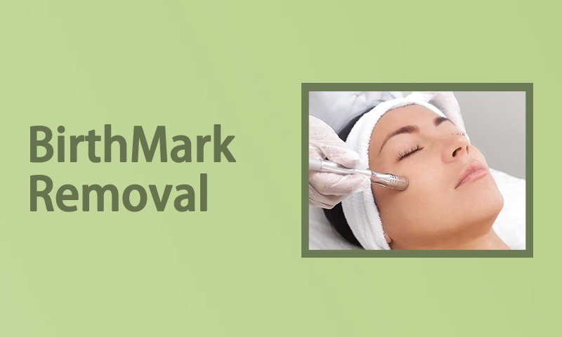 BirthMark Removal  in Surat, Gujarat (India)