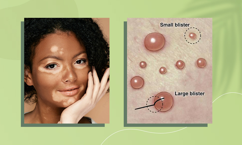 Blister Therapy For Vitiligo