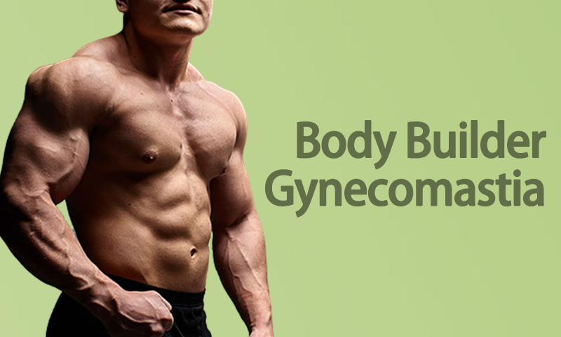 Body Builder Gynecomastia in Surat