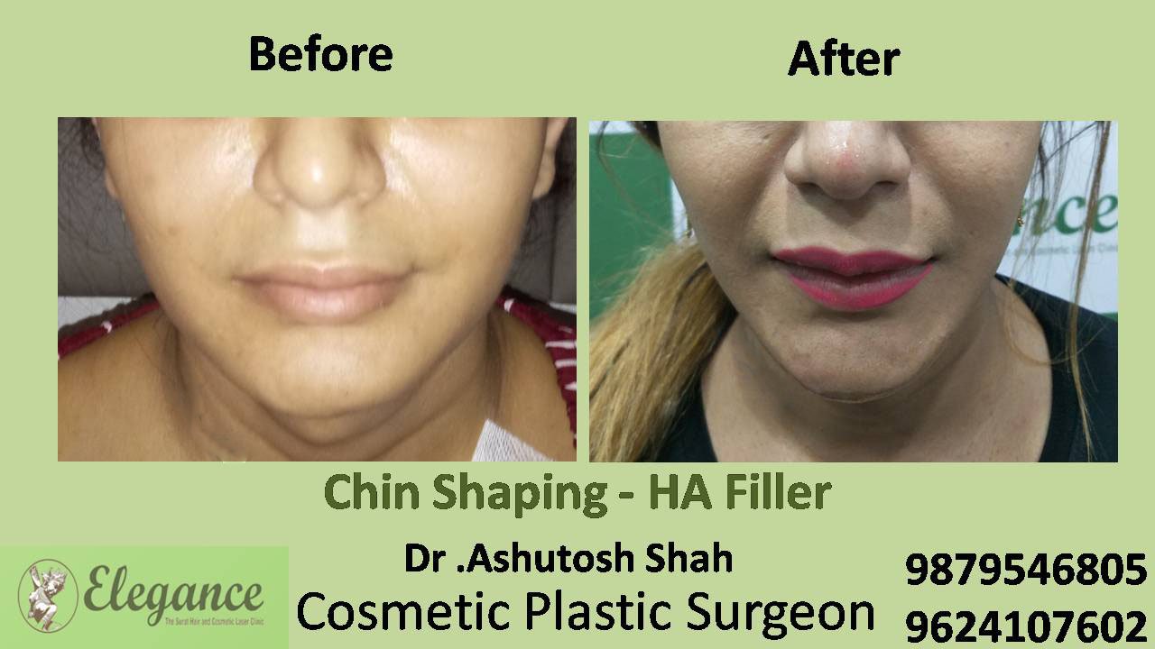 Chin Augmentation