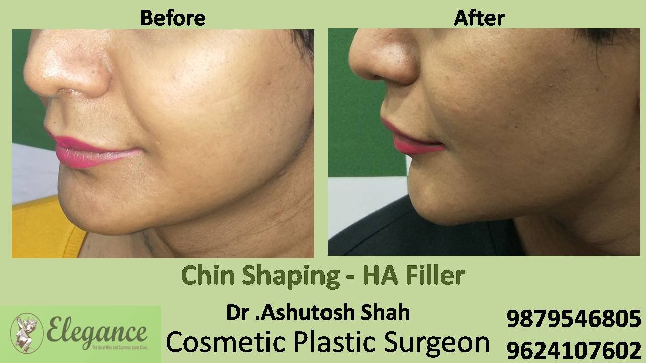 Chin Augmentation