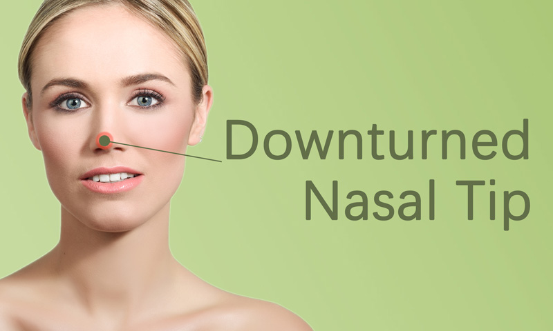 Downturned Nasal Tip Botox Fillers Treatment in Surat, Gujarat (India)