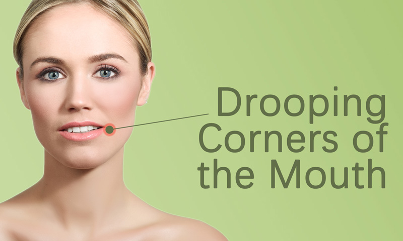 Drooping Corners of the Mouth Botox Fillers Treatment in Surat, Gujarat (India)