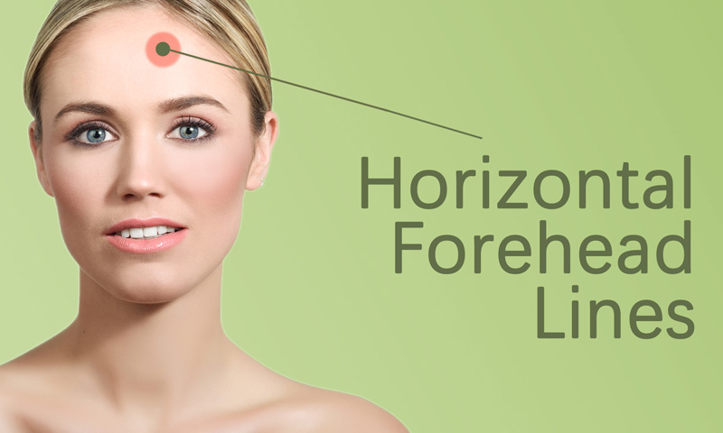 Horizontal Forehead Lines Treatment in Surat, Gujarat (India)
