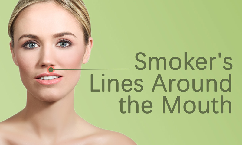 Smoker's Lines Around the Mouth Botox Fillers Treatment in Surat, Gujarat (India), Botox for Smoker's Lines