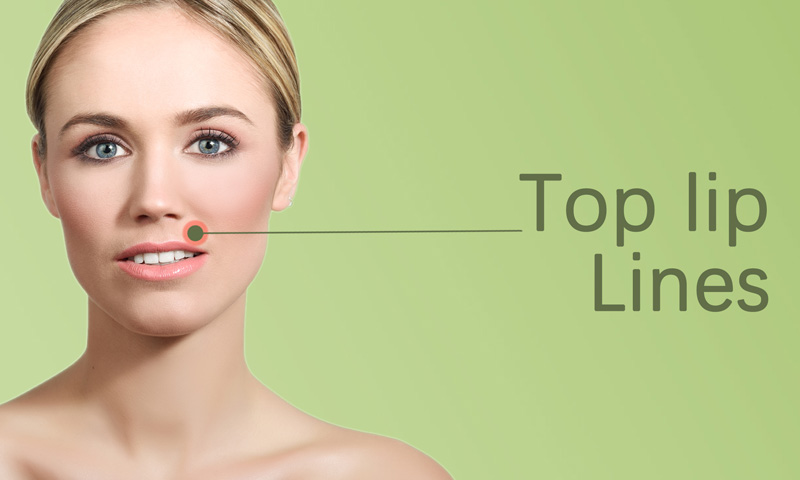 Top Lip Lines Fillers in Surat, Gujarat (India)