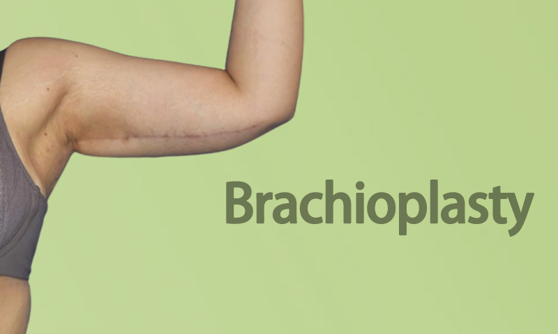 Brachioplasty
