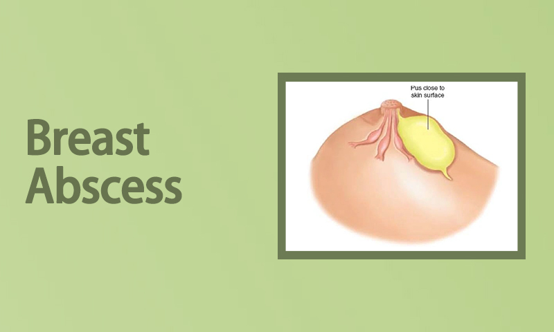 Breast Abscess Treatment in Surat, Gujarat (India)