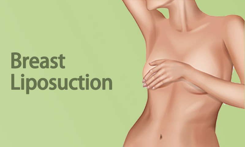 Breast Liposuction Surgery in Surat, Gujarat (India)