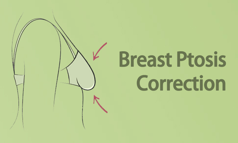 Breast Ptosis Correction Surgery in Surat, Gujarat (India)