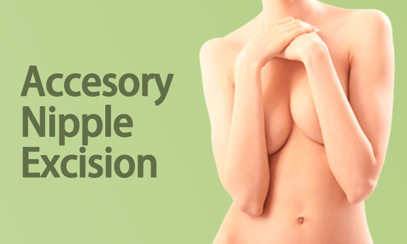 Accesory Nipple Excision in Surat, Gujarat (India)