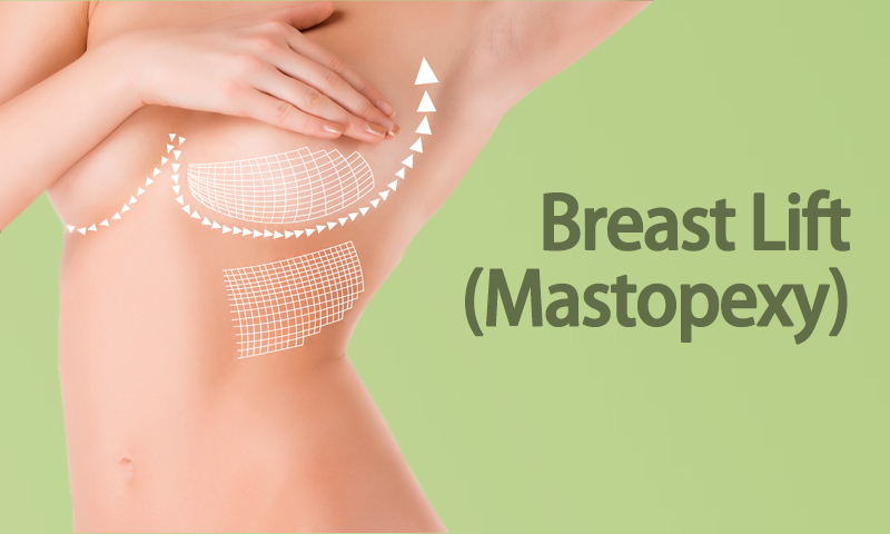 Breast Lift​ (Mastopexy) Surgery in Surat, Gujarat (India)