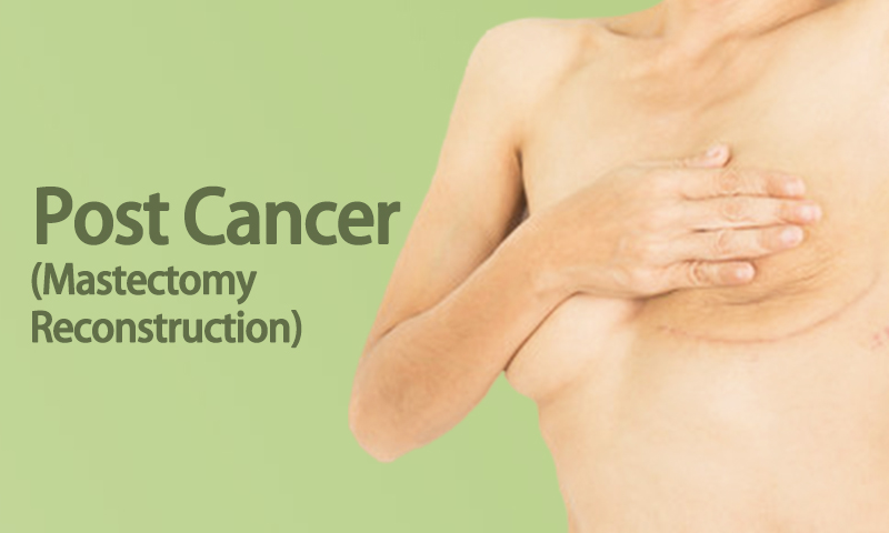 Post Breast Cancer (Mastectomy Reconstruction) in Surat, Gujarat (India)