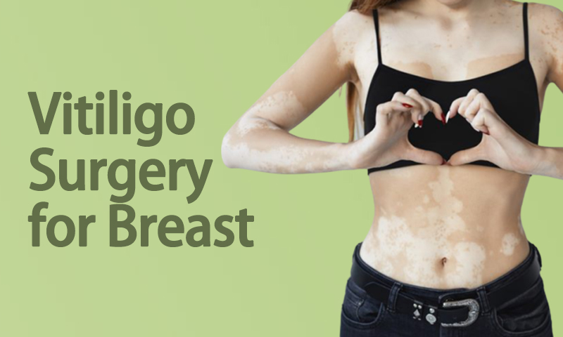Vitiligo Surgery For Breast in Surat, Gujarat (India)