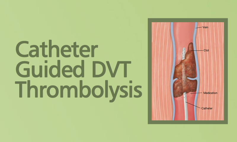 Catheter Guided DVT Thrombolysis