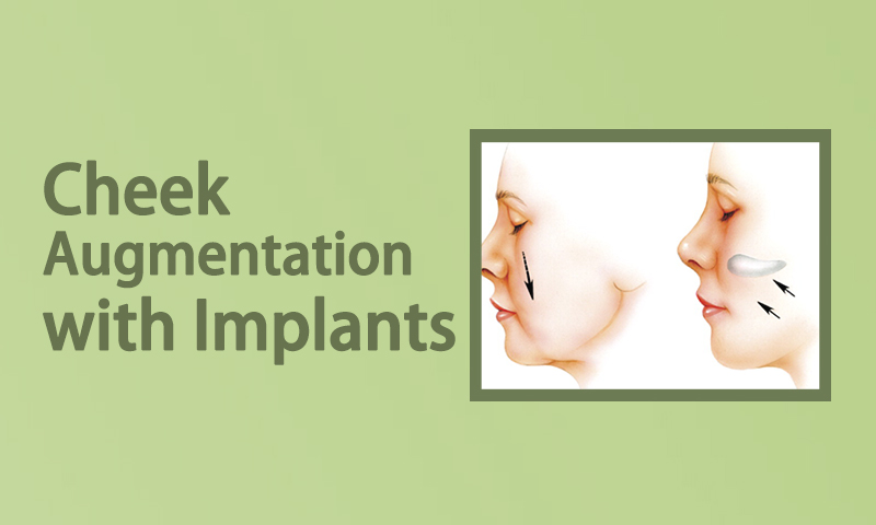 Cheek Augmentation with Implants in Surat, Gujarat (India)