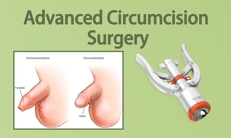 Advanced Circumcision Surgery