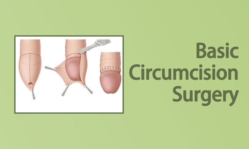 Basic Circumcision Surgery in Surat, Gujarat (India) Sunnat Surgery