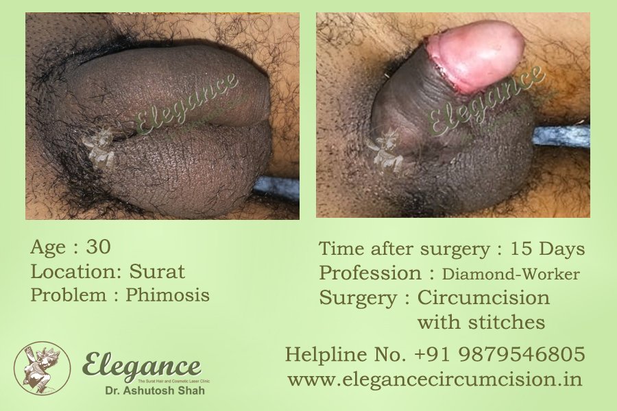 Basic Circumcision Surgery in Surat, Gujarat (India) Sunnat Surgery