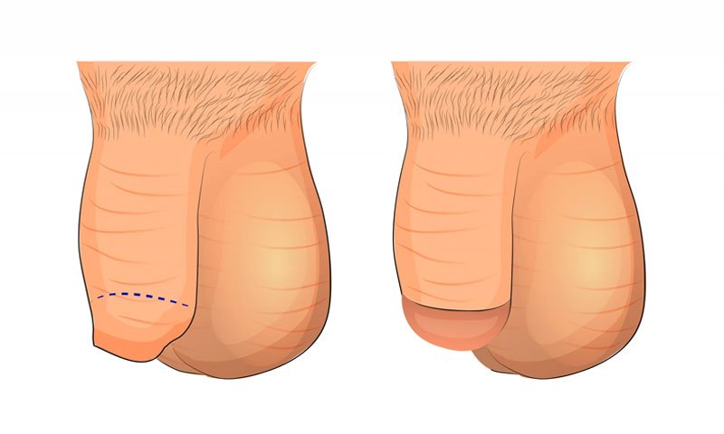 Scrotal Web Correction