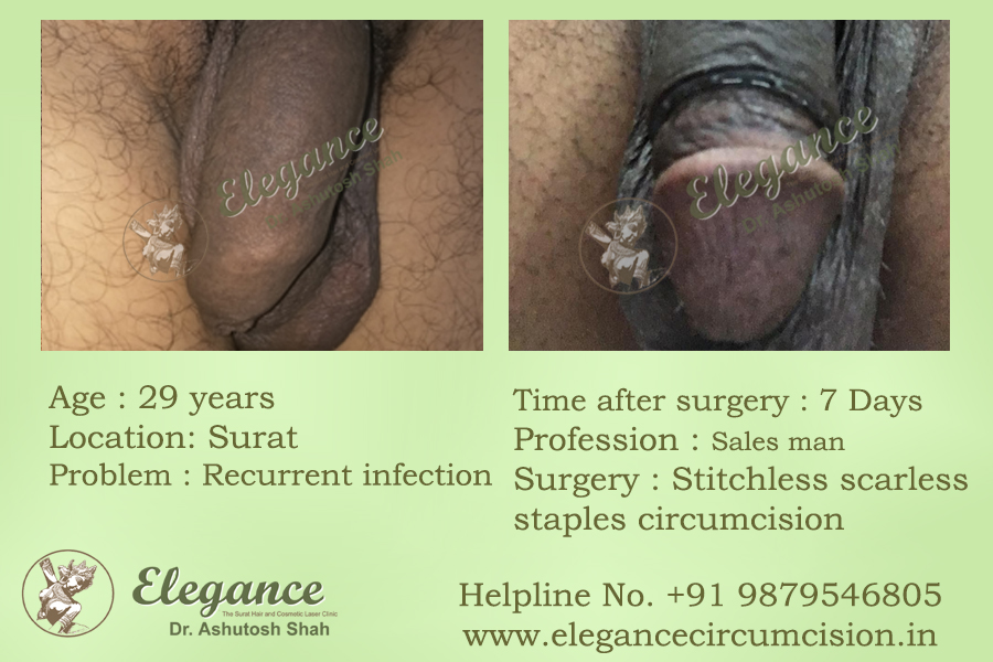 Advanced Circumcision Surgery