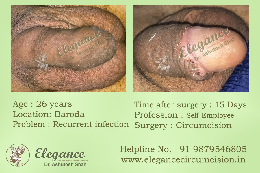 Basic Circumcision Surgery in Surat, Gujarat (India) Sunnat Surgery