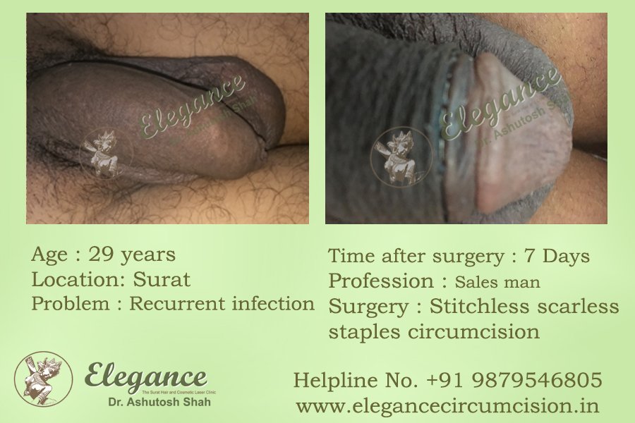 Advanced Circumcision Surgery